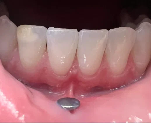 Do Labret Piercings Damage Your Teeth? What You Need to Know